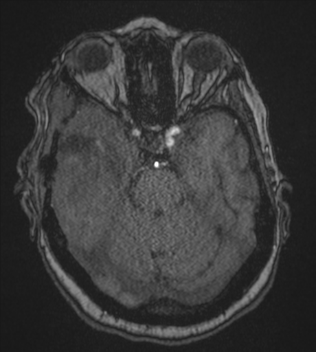 Atypical meningioma (WHO Grade II) (Radiopaedia 54742-60981 Axial MRA 33).png