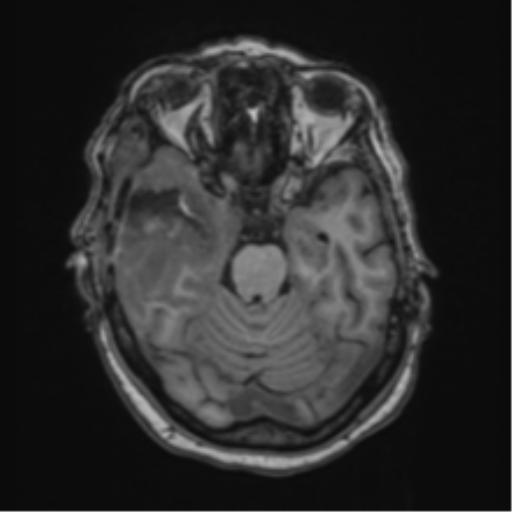 Atypical meningioma (WHO Grade II) (Radiopaedia 54742-60981 Axial T1 24).png