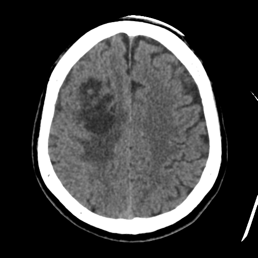 Atypical meningioma (WHO grade II) with osseous invasion (Radiopaedia 53654-59715 Axial non-contrast 38).png