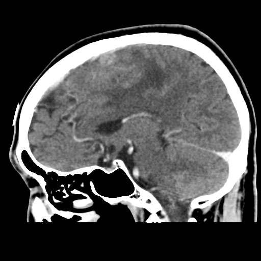 Atypical meningioma (WHO grade II) with osseous invasion (Radiopaedia 53654-59715 G 26).png