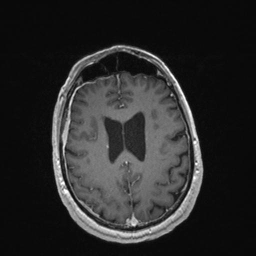 Atypical meningioma (grade II) - en plaque (Radiopaedia 29633-30147 Axial T1 C+ 128).jpg