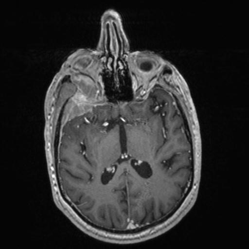 Atypical meningioma (grade II) - en plaque (Radiopaedia 29633-30147 Axial T1 C+ 95).jpg