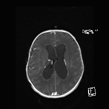 File:Atypical teratoid rhabdoid tumor (prenatal US and neonatal MRI) (Radiopaedia 59091-66388 Axial T1 C+ 39).jpg