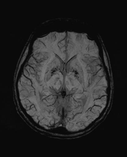 Autoimmune limbic encephalitis (Radiopaedia 30363-31005 SWI - mIP 34).jpg