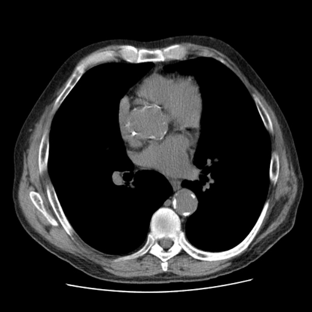 Autosomal dominant polycystic kidney disease (Radiopaedia 27851-28094 Axial non-contrast 31).jpg