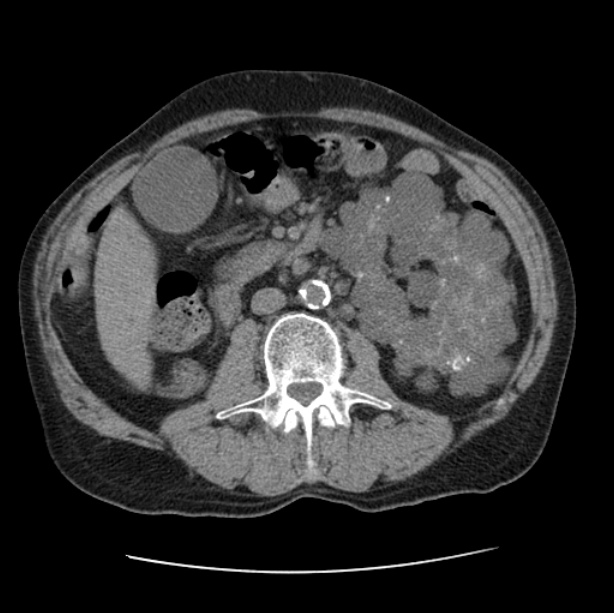 Autosomal dominant polycystic kidney disease (Radiopaedia 27851-28094 Axial non-contrast 73).jpg