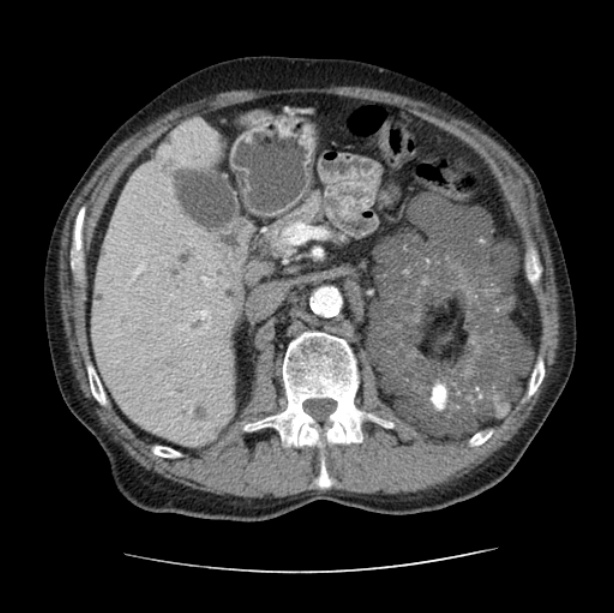 Autosomal dominant polycystic kidney disease (Radiopaedia 27851-28094 B 67).jpg
