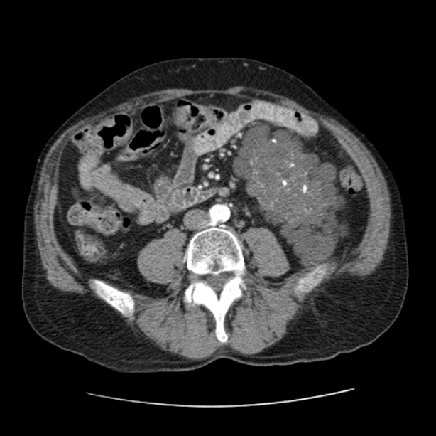 Autosomal dominant polycystic kidney disease (Radiopaedia 27851-28094 B 83).jpg