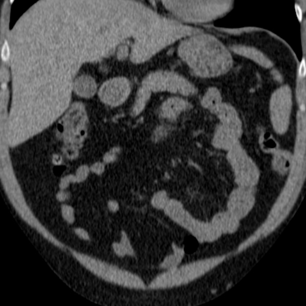 File:Autosomal dominant polycystic kidney disease (Radiopaedia 36539-38101 Coronal non-contrast 2).jpg