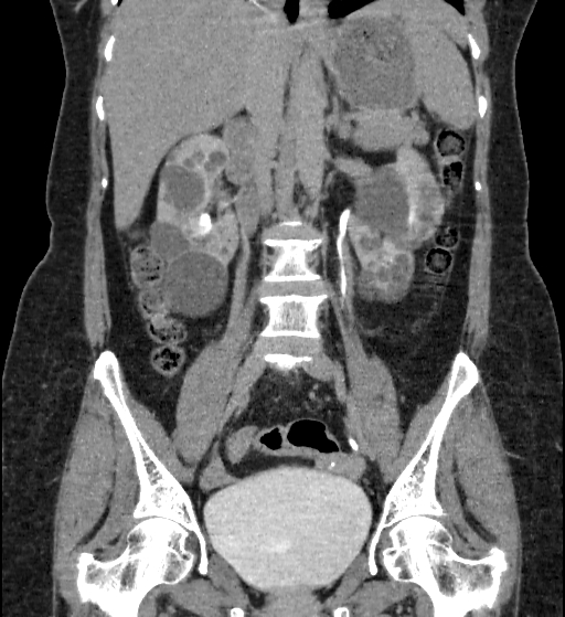 Autosomal dominant polycystic kidney disease (Radiopaedia 38189-40194 Coronal C+ delayed 48).jpg