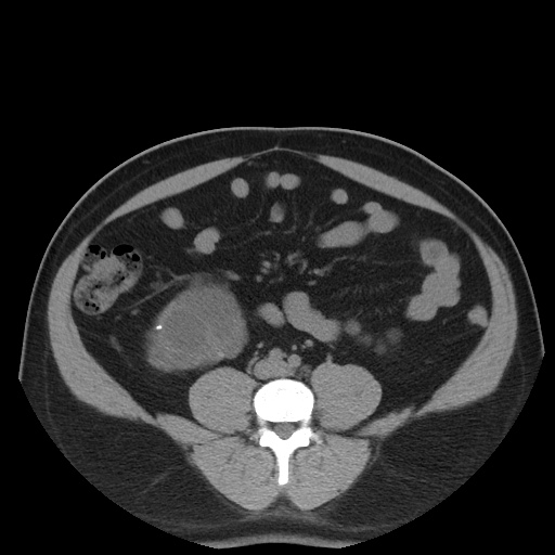 Autosomal dominant polycystic kidney disease (Radiopaedia 50259-55612 Axial non-contrast 53).jpg