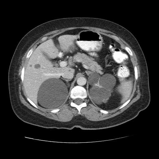 File:Autosomal dominant polycystic kidney disease with hepatic involvement (Radiopaedia 32693-33662 B 22).jpg