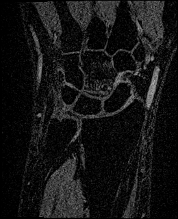Avascular necrosis of the capitate (Radiopaedia 88317-104948 Coronal T1 vibe 30).jpg