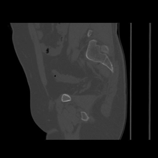 Avascular necrosis of the hip (Radiopaedia 61503-69467 B 38).jpg