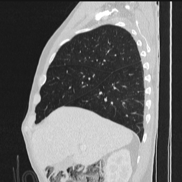 Azygos lobe (Radiopaedia 38259-40275 lung window 27).jpg