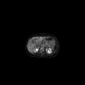 B-cell lymphoma of the mesentery (Radiopaedia 65743-74868 18F-FDG PET-CT 157).jpg