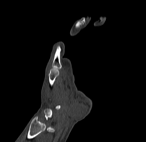 Base of 2nd metacarpal fracture (Radiopaedia 73741-84544 Coronal bone window 26).jpg