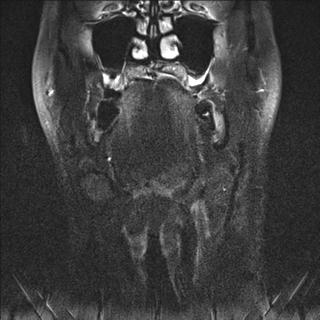 File:Base of tongue squamous cell carcinoma (Radiopaedia 31174-31884 Coronal T2 fat sat 16).jpg