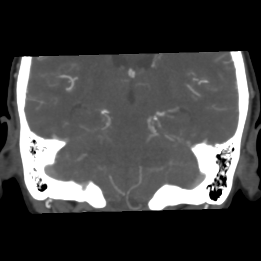 File:Basilar artery fenestration and aneurysms with subarachnoid hemorrhage (Radiopaedia 40066-42573 B 34).png