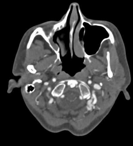 Basilar tip aneurysm with coiling (Radiopaedia 53912-60086 A 15).jpg