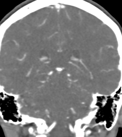 Basilar tip aneurysm with coiling (Radiopaedia 53912-60086 B 100).jpg