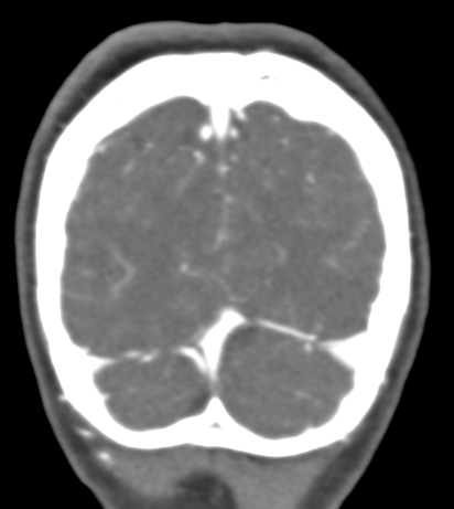 Basilar tip aneurysm with coiling (Radiopaedia 53912-60086 B 141).jpg