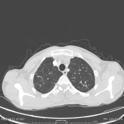 File:Behçet disease (Radiopaedia 44247-47889 Axial lung window 11).jpg