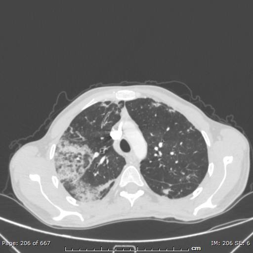 File:Behçet disease (Radiopaedia 44247-47889 Axial lung window 24).jpg