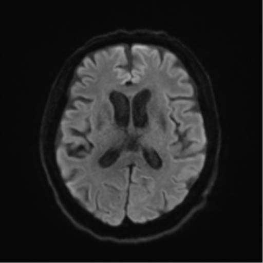 Behavioral variant frontotemporal dementia and late onset schizophrenia (Radiopaedia 52197-58083 Axial DTI Trace W 42).png