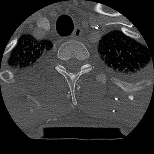 Benign post-traumatic pseudopneumoperitoneum (Radiopaedia 71199-81495 Axial bone window 38).jpg