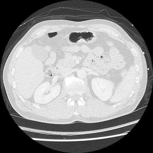 Benign post-traumatic pseudopneumoperitoneum (Radiopaedia 71199-81495 Axial lung window 77).jpg