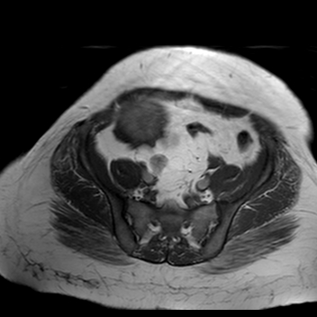 File:Benign seromucinous cystadenoma of the ovary (Radiopaedia 71065-81300 Axial T1 13).jpg
