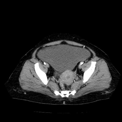 Benign spindle cell tumor - abdominopelvic (Radiopaedia 61300-69212 A 51).jpg