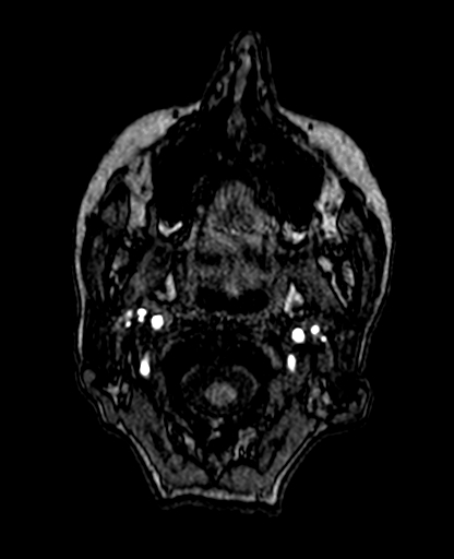 Berry aneurysm of the terminal internal carotid artery (Radiopaedia 88286-104918 Axial TOF 12).jpg