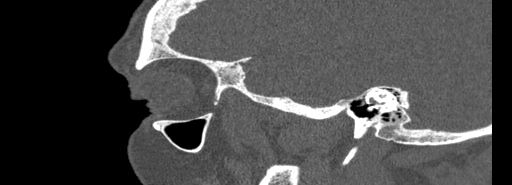 Bilateral Ectopic Infraorbital Nerves (Radiopaedia 49006-54084 Sagittal bone window 49).jpg