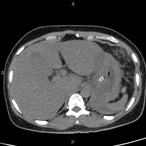Bilateral adrenal gland hyperenhancement in pancreatitis (Radiopaedia 86642-102753 Axial non-contrast 20).jpg