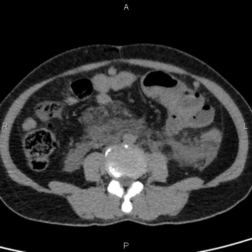 Bilateral adrenal gland hyperenhancement in pancreatitis (Radiopaedia 86642-102753 Axial non-contrast 67).jpg