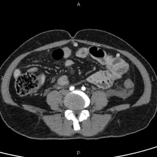 Bilateral adrenal gland hyperenhancement in pancreatitis (Radiopaedia 86642-102753 B 88).jpg
