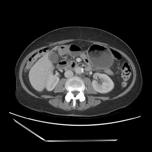 Bilateral adrenal granulocytic sarcomas (chloromas) (Radiopaedia 78375-91007 A 59).jpg