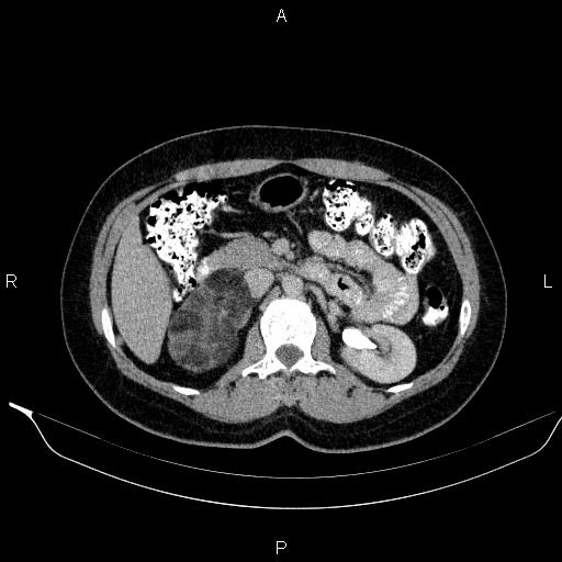 File:Bilateral adrenal myelolipoma (Radiopaedia 63058-71535 Axial C+ delayed 45).jpg
