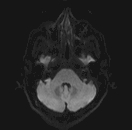 File:Bilateral and symmetric thalamic glioma (Radiopaedia 66119-75289 Axial DWI 5).jpg