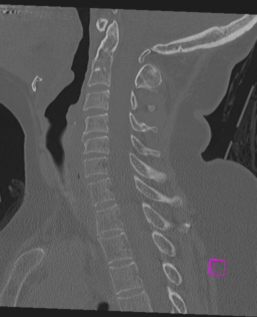 Bilateral atlanto-occipital assimilation (Radiopaedia 28350-28603 Sagittal bone window 39).jpg