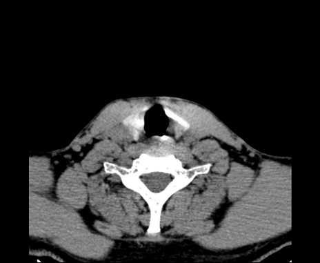 Bilateral carotid body tumors (Radiopaedia 61841-69870 Axial non-contrast 87).jpg