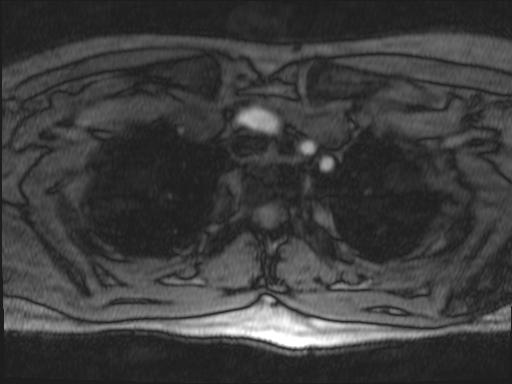 Bilateral carotid body tumors and right glomus jugulare tumor (Radiopaedia 20024-20060 Axial MRA 172).jpg
