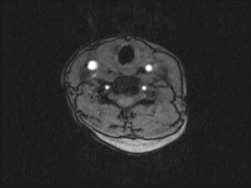 Bilateral carotid body tumors and right glomus jugulare tumor (Radiopaedia 20024-20060 Axial MRA 227).jpg