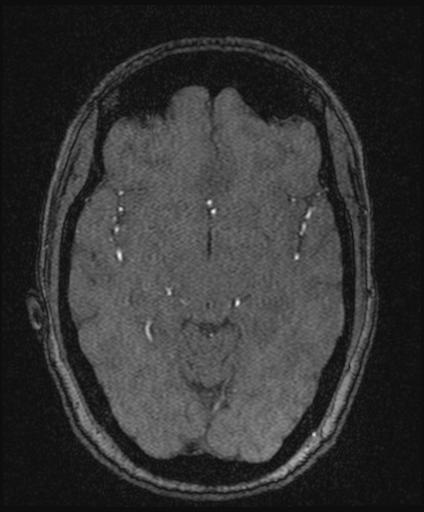 Bilateral carotid body tumors and right glomus jugulare tumor (Radiopaedia 20024-20060 Axial MRA 82).jpg