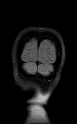 File:Bilateral carotid body tumors and right jugular paraganglioma (Radiopaedia 20024-20060 Coronal 74).jpg