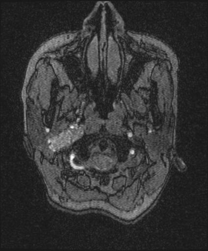 File:Bilateral carotid body tumors and right jugular paraganglioma (Radiopaedia 20024-20060 Sagittal 19).jpg