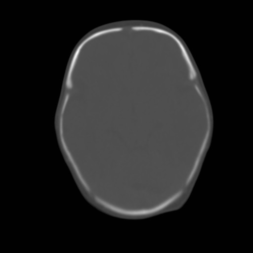File:Bilateral cephalohematomas and subdural hematomas (Radiopaedia 26778-26929 Axial bone window 8).jpg