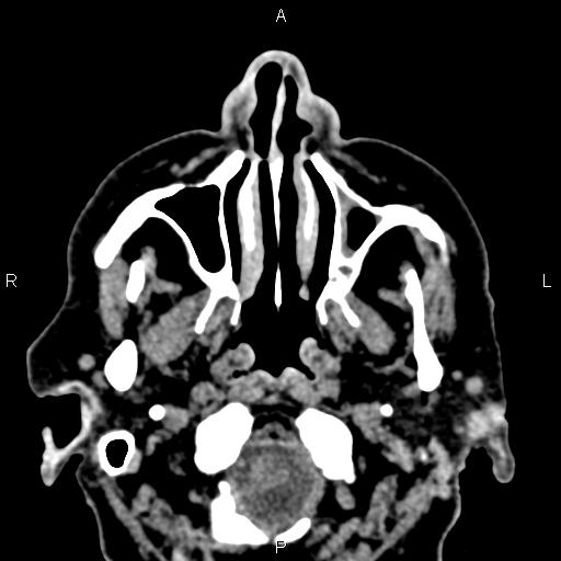 Bilateral enlargement of lacrimal glands - sarcoidosis (Radiopaedia 62627-70921 Axial non-contrast 1).jpg